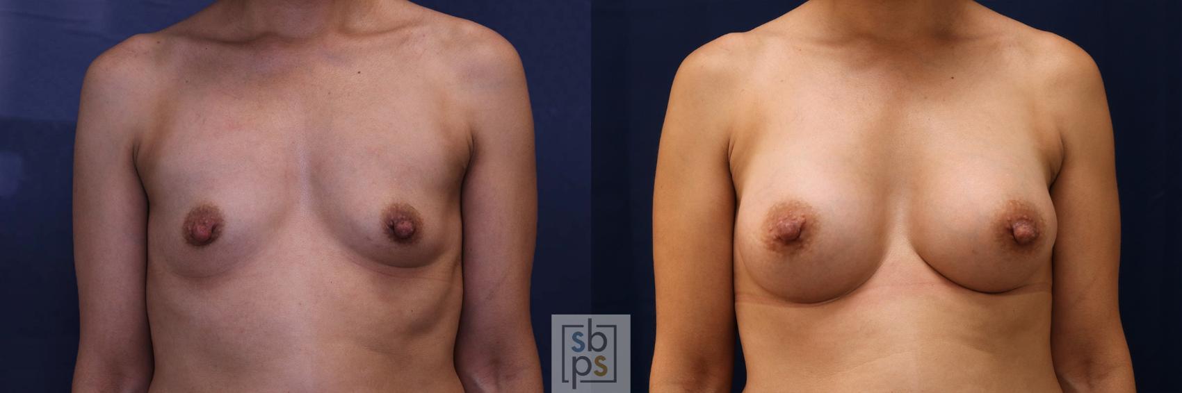 Before & After Breast Augmentation Case 530 Front View in Torrance, CA
