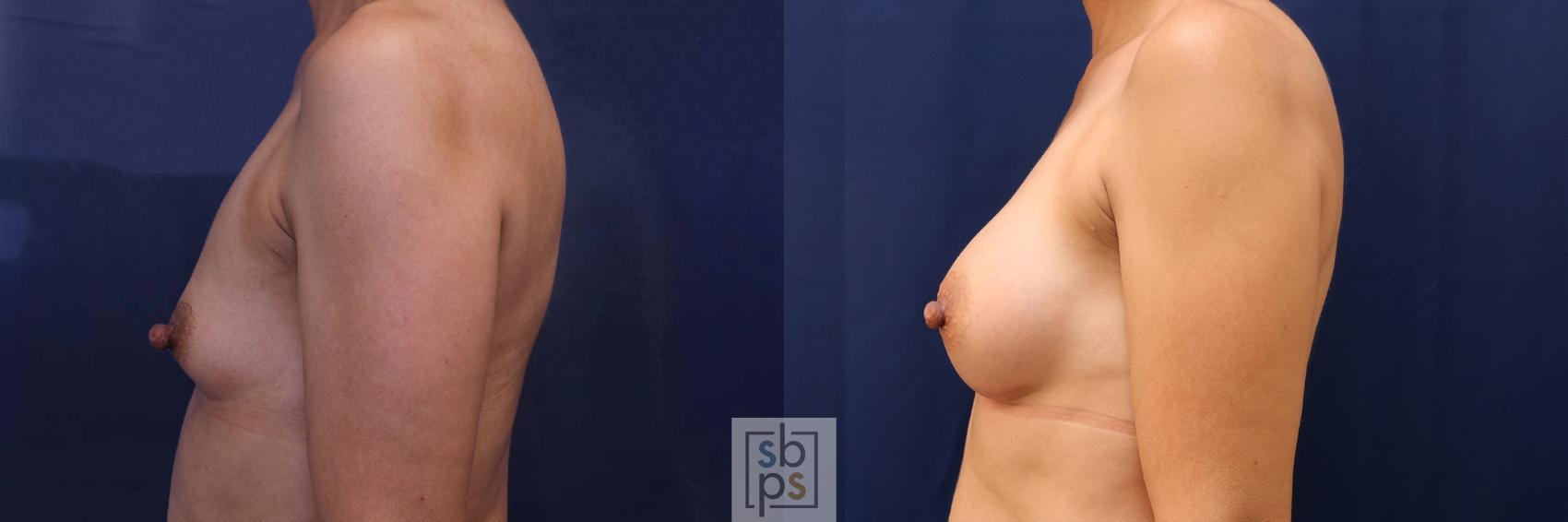 Before & After Breast Augmentation Case 530 Left Side View in Los Angeles, Torrance & Long Beach, CA