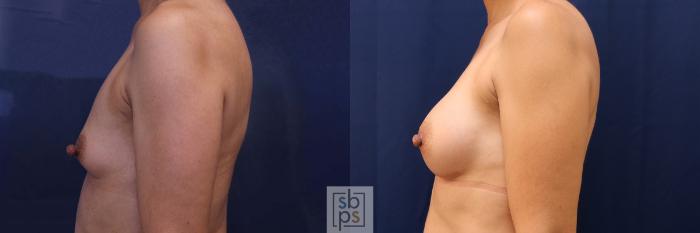 Before & After Breast Augmentation Case 530 Left Side View in Torrance, CA