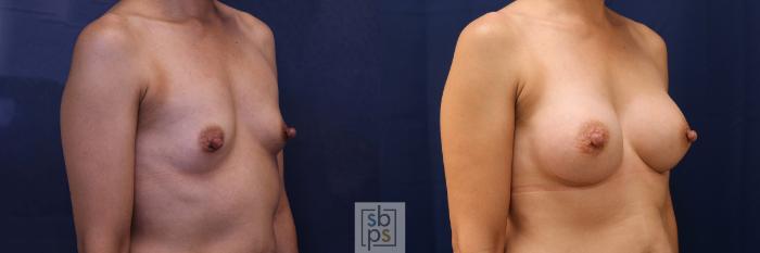 Before & After Breast Augmentation Case 530 Right Oblique View in Torrance, CA