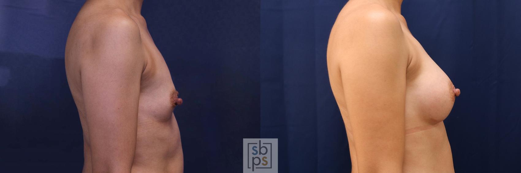 Before & After Breast Augmentation Case 530 Right Side View in Los Angeles, Torrance & Long Beach, CA