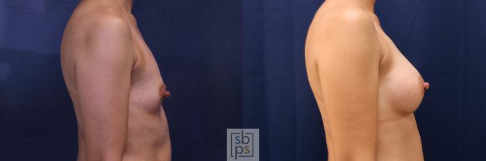 Before & After Breast Augmentation Case 530 Right Side View in Torrance, CA