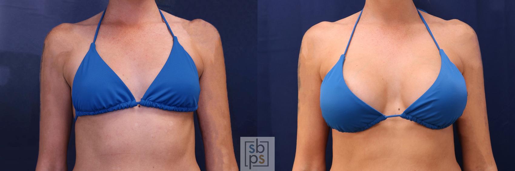 Before & After Breast Augmentation Case 534 Bikini Front View in Los Angeles, Torrance & Long Beach, CA