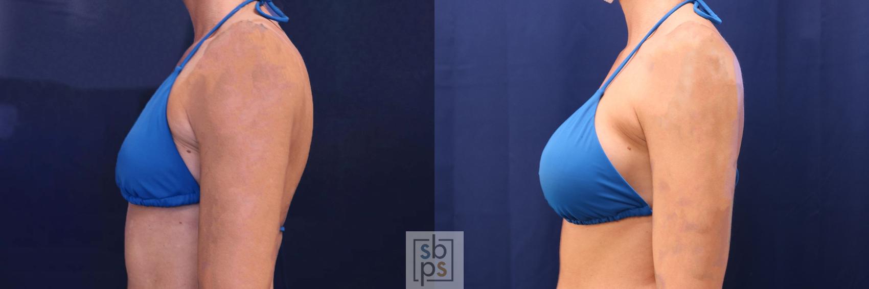 Before & After Breast Augmentation Case 534 Bikini Left View in Los Angeles, Torrance & Long Beach, CA