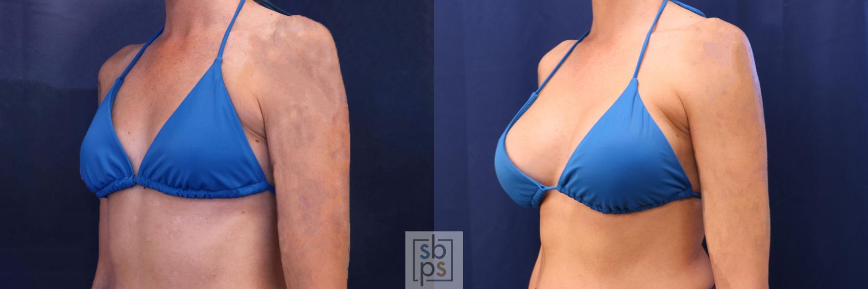 Before & After Breast Augmentation Case 534 Bikini Left Oblique View in Los Angeles, Torrance & Long Beach, CA