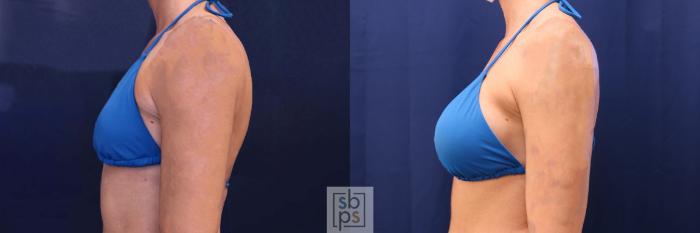 Before & After Breast Augmentation Case 534 Bikini Left View in Torrance, CA