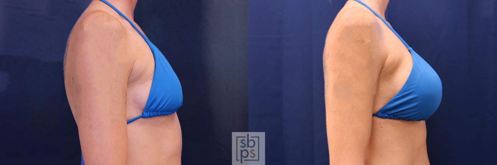 Before & After Breast Augmentation Case 534 Bikini Right View in Los Angeles, Torrance & Long Beach, CA