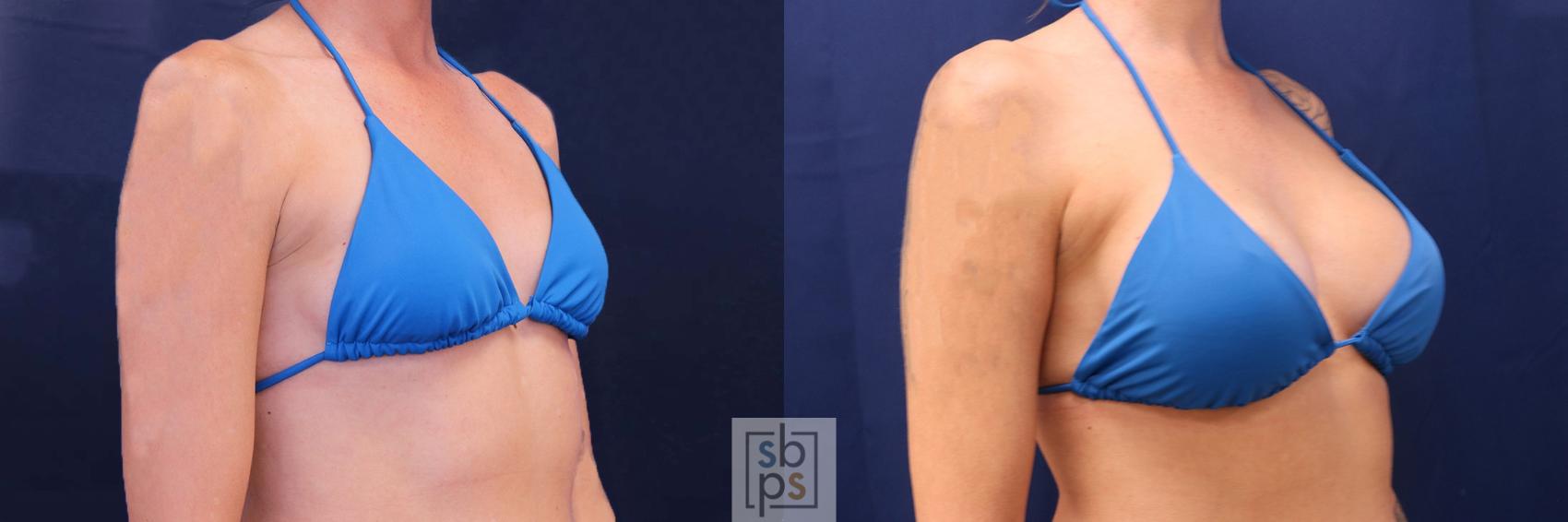 Before & After Breast Augmentation Case 534 Bikini Right Oblique View in Los Angeles, Torrance & Long Beach, CA