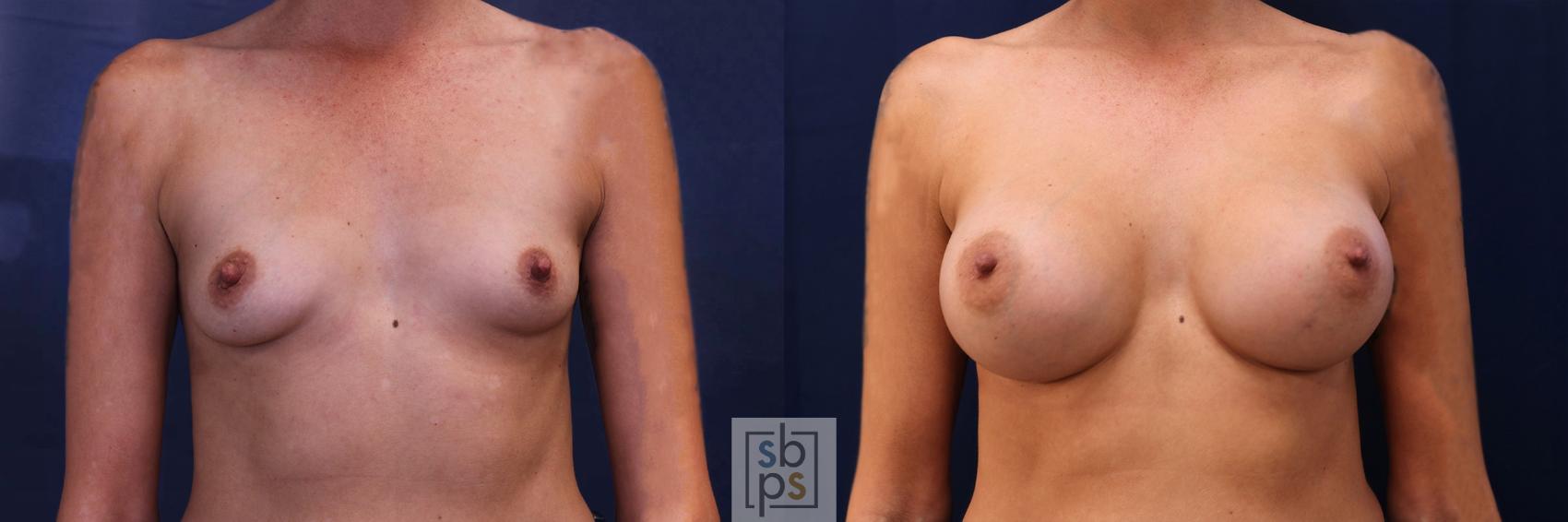 Before & After Breast Augmentation Case 534 Front View in Torrance, CA