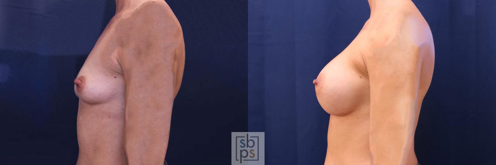 Before & After Breast Augmentation Case 534 Left Side View in Los Angeles, Torrance & Long Beach, CA