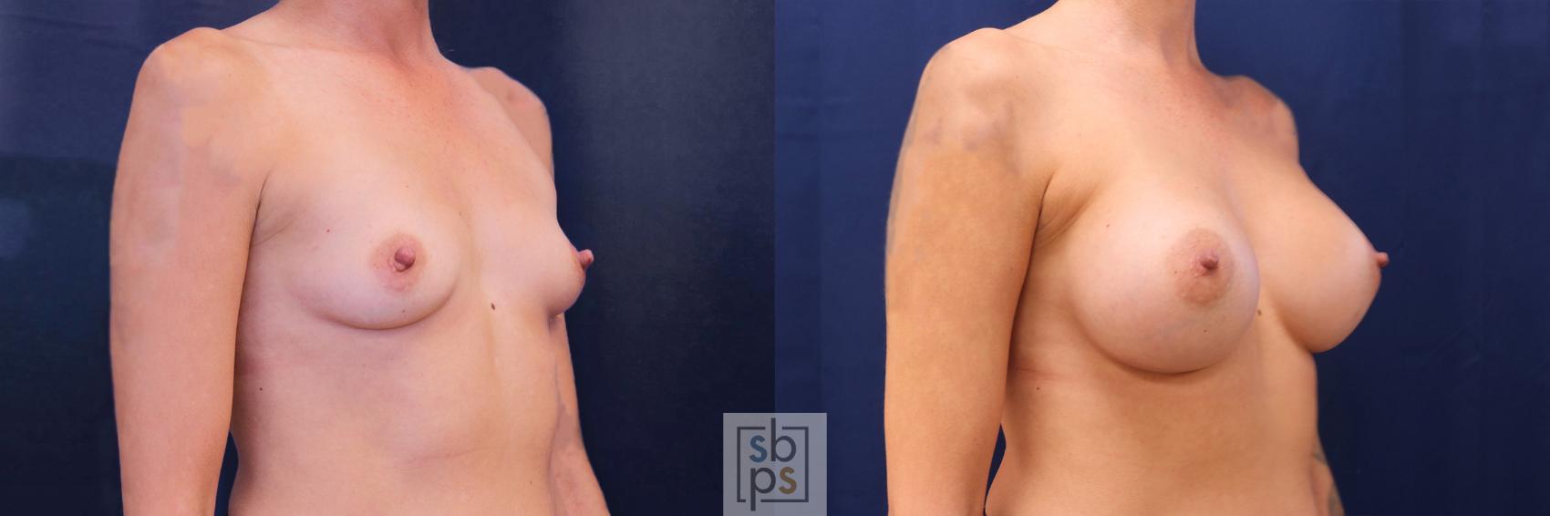 Before & After Breast Augmentation Case 534 Right Oblique View in Los Angeles, Torrance & Long Beach, CA