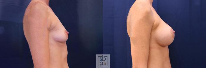 Before & After Breast Augmentation Case 534 Right Side View in Torrance, CA