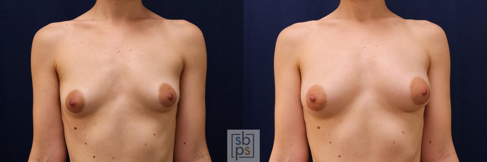 Before & After Breast Augmentation Case 546 Front View in Torrance, CA