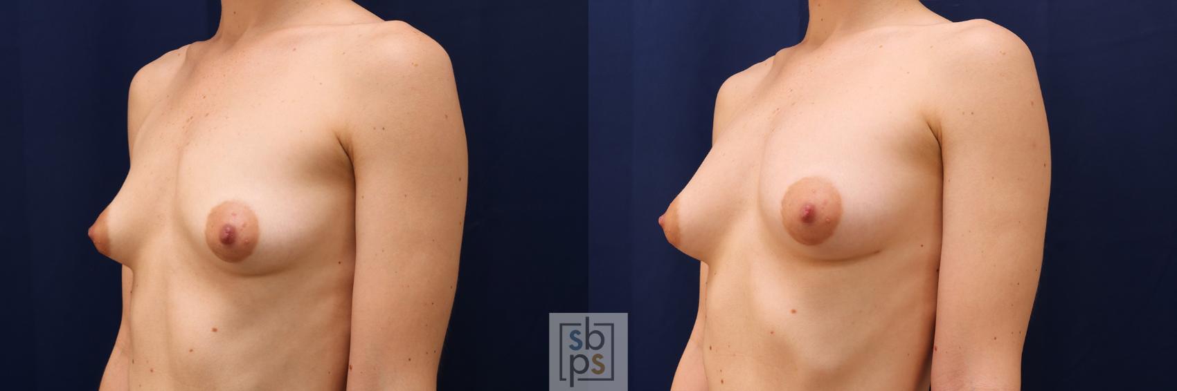 Before & After Breast Augmentation Case 546 Left Oblique View in Los Angeles, Torrance & Long Beach, CA