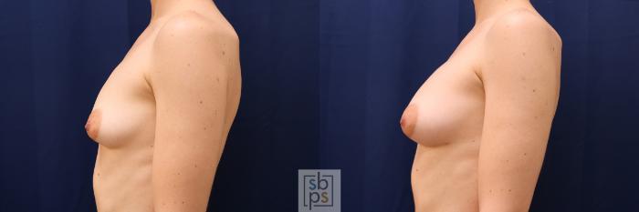 Before & After Breast Augmentation Case 546 Left Side View in Torrance, CA