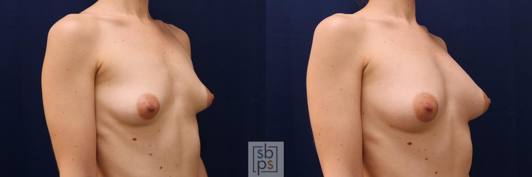 Before & After Breast Augmentation Case 546 Right Oblique View in Los Angeles, Torrance & Long Beach, CA