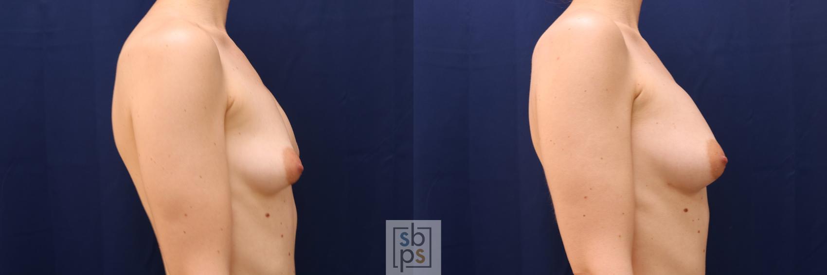 Before & After Breast Augmentation Case 546 Right Side View in Los Angeles, Torrance & Long Beach, CA