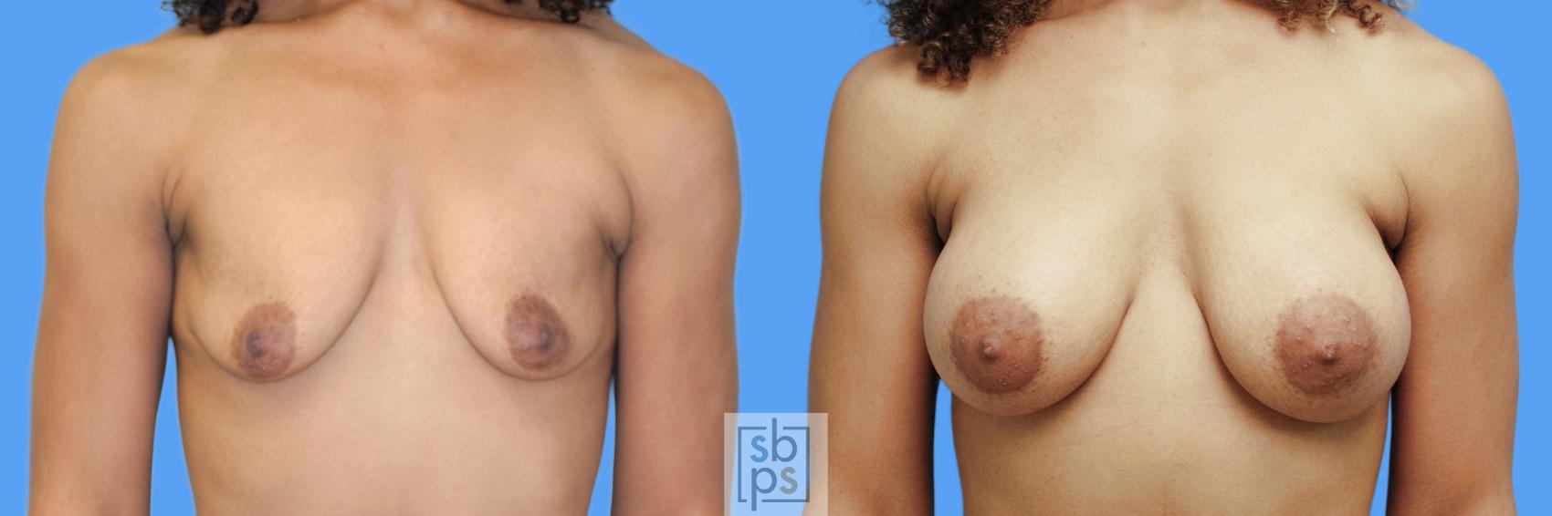 Before & After Breast Augmentation Case 55 View #1 View in Torrance, CA