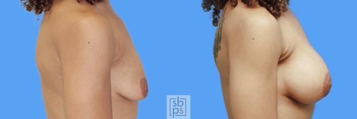 Before & After Breast Augmentation Case 55 View #2 View in Torrance, CA