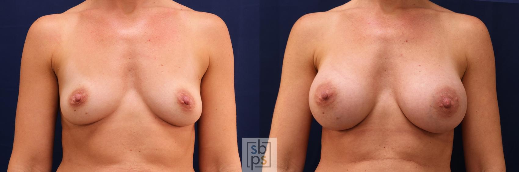 Before & After Breast Augmentation Case 551 Front View in Torrance, CA