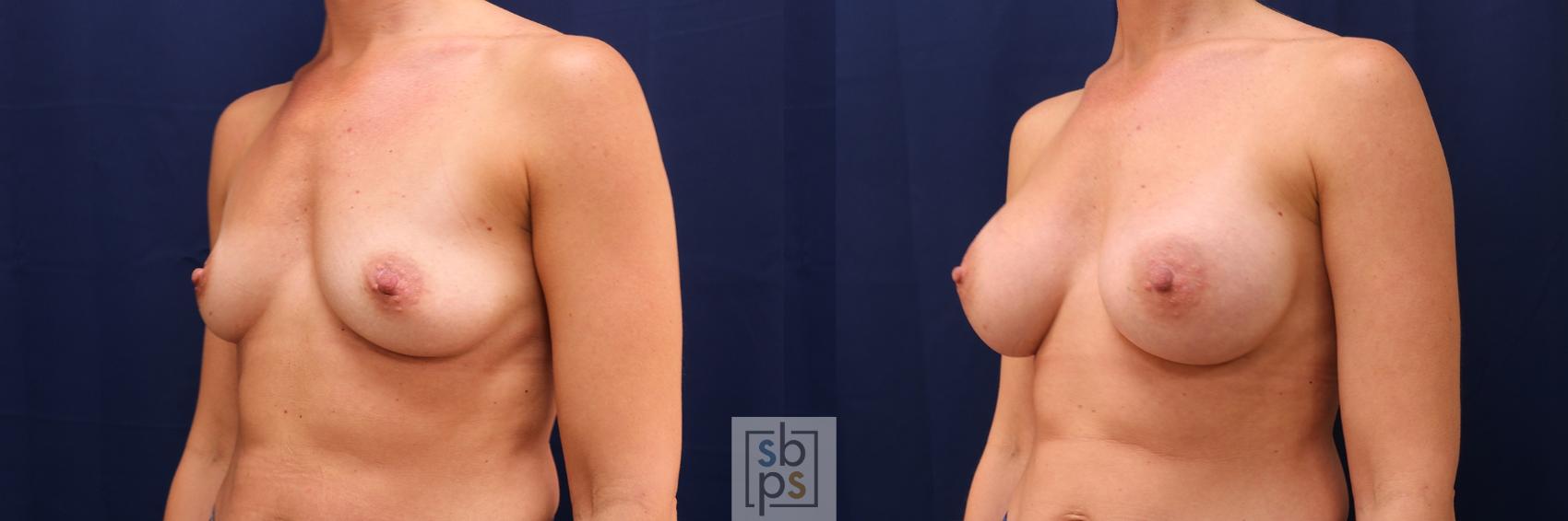 Before & After Breast Augmentation Case 551 Left Oblique View in Los Angeles, Torrance & Long Beach, CA