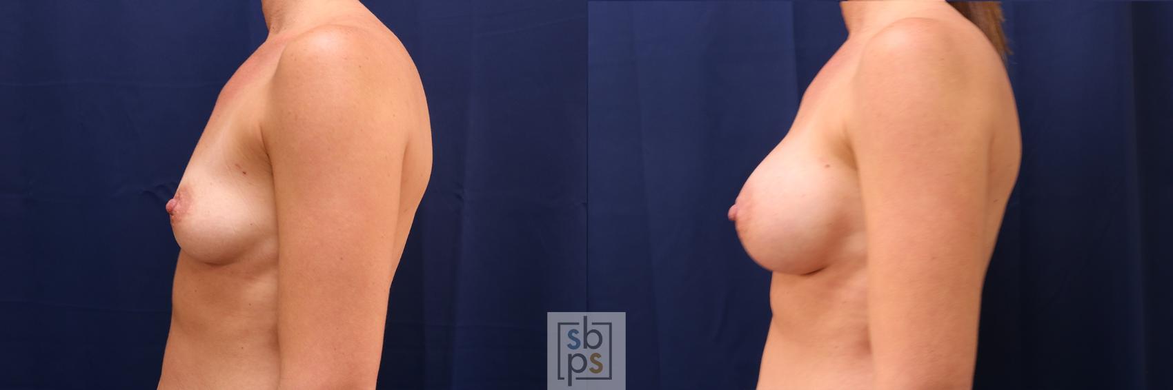 Before & After Breast Augmentation Case 551 Left Side View in Los Angeles, Torrance & Long Beach, CA