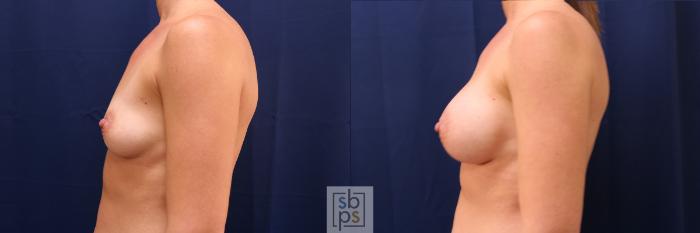Before & After Breast Augmentation Case 551 Left Side View in Torrance, CA