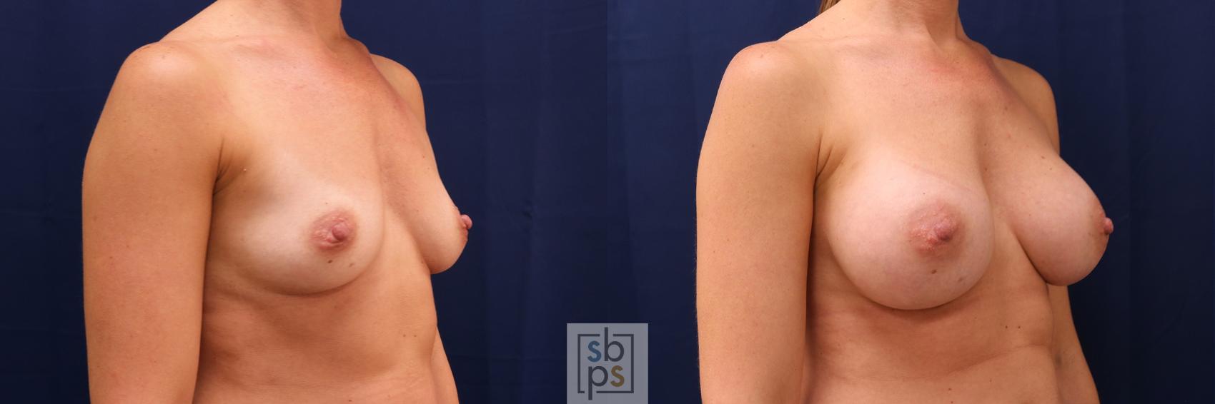 Before & After Breast Augmentation Case 551 Right Oblique View in Los Angeles, Torrance & Long Beach, CA