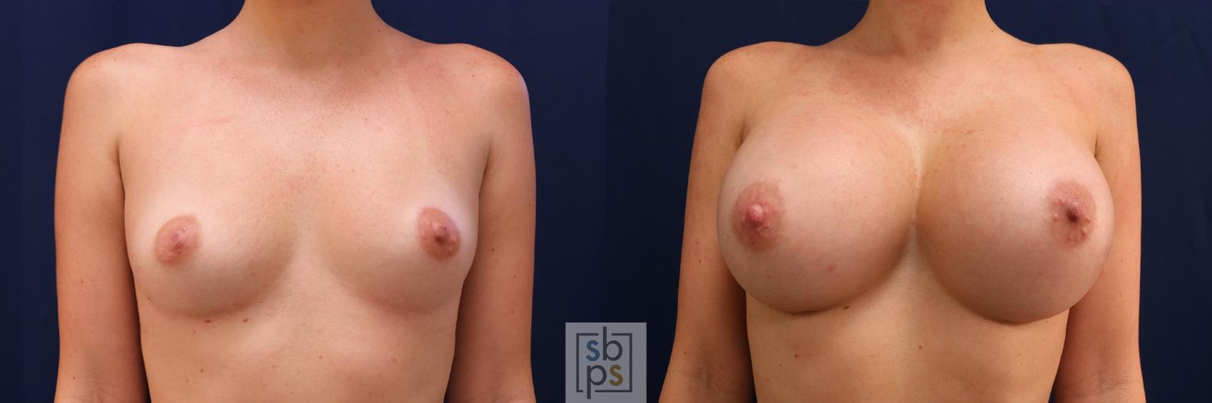 Before & After Breast Augmentation Case 554 Front View in Torrance, CA