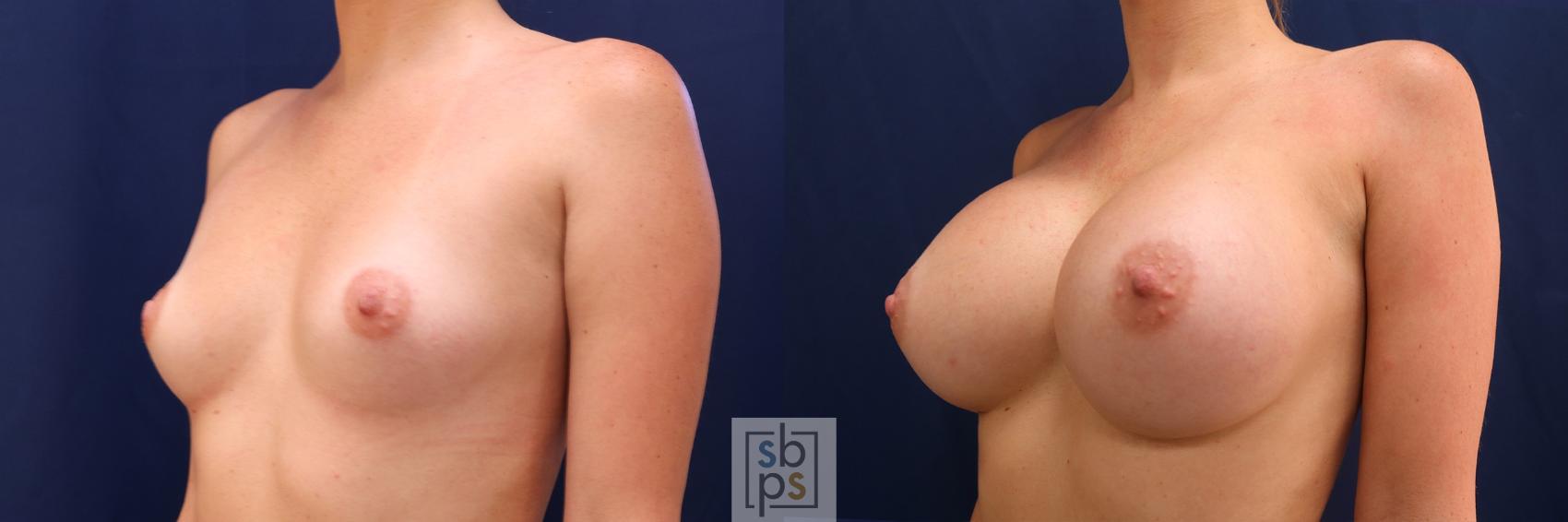 Before & After Breast Augmentation Case 554 Left Oblique View in Los Angeles, Torrance & Long Beach, CA