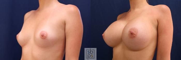 Before & After Breast Augmentation Case 554 Left Oblique View in Torrance, CA