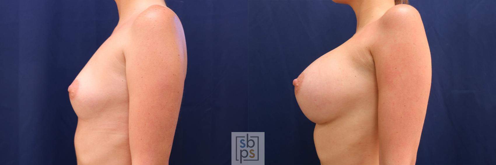 Before & After Breast Augmentation Case 554 Left Side View in Los Angeles, Torrance & Long Beach, CA