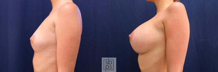 Before & After Breast Augmentation Case 554 Left Side View in Torrance, CA