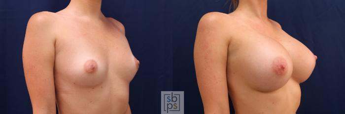 Before & After Breast Augmentation Case 554 Right Oblique View in Torrance, CA