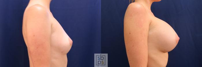 Before & After Breast Augmentation Case 554 Right Side View in Torrance, CA