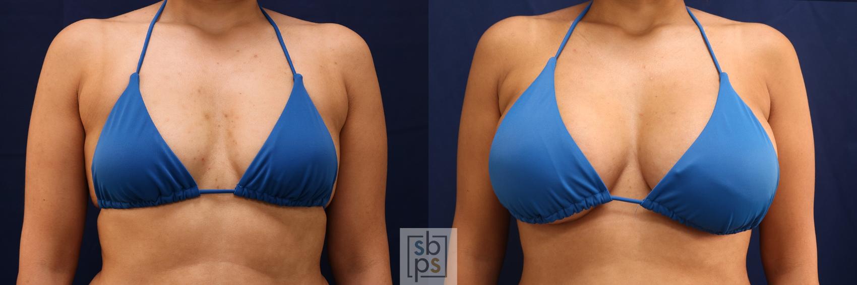 Before & After Breast Augmentation Case 555 Bikini Front View in Los Angeles, Torrance & Long Beach, CA
