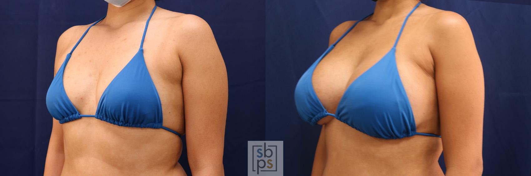 Before & After Breast Augmentation Case 555 Bikini Left Oblique View in Los Angeles, Torrance & Long Beach, CA