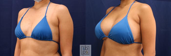 Before & After Breast Augmentation Case 555 Bikini Left Oblique View in Torrance, CA