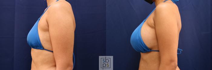 Before & After Breast Augmentation Case 555 Bikini Left View in Torrance, CA