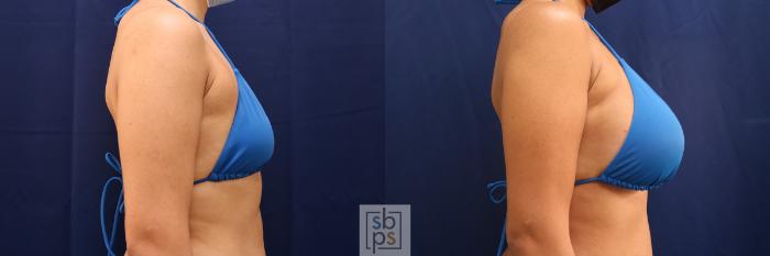 Before & After Breast Augmentation Case 555 Bikini Right View in Torrance, CA