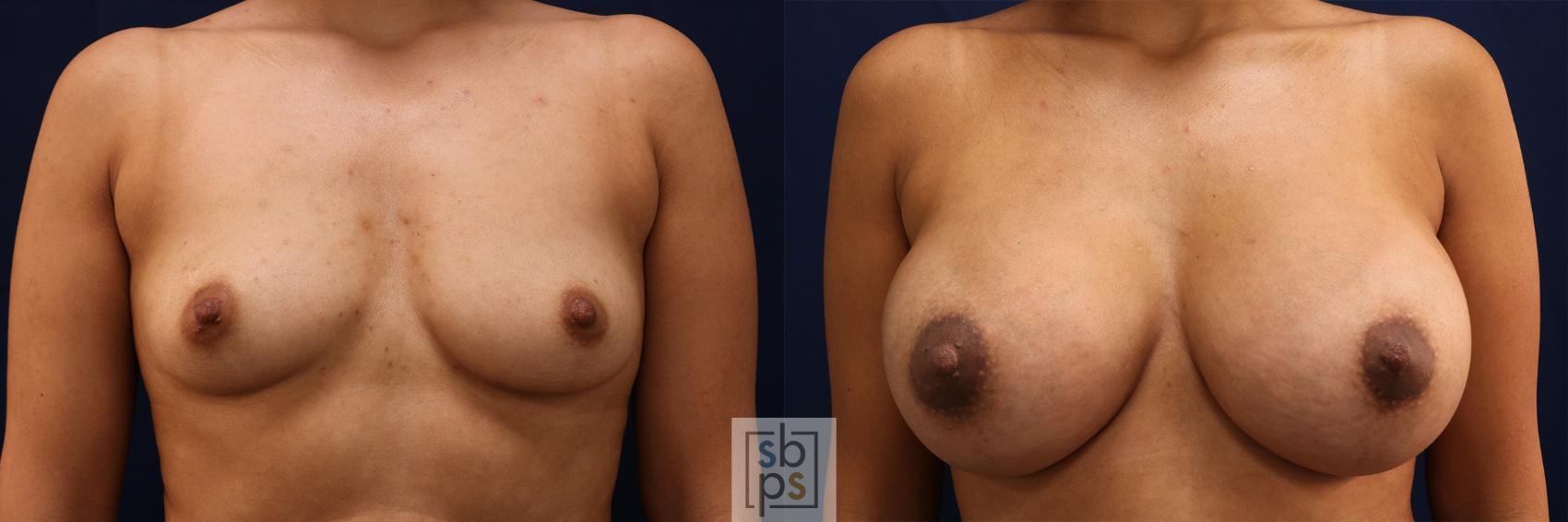 Before & After Breast Augmentation Case 555 Front View in Torrance, CA