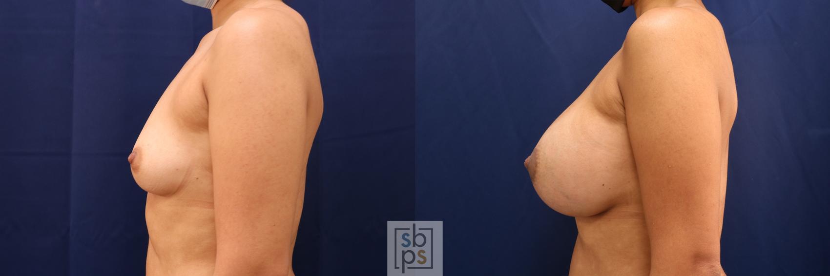 Before & After Breast Augmentation Case 555 Left Side View in Los Angeles, Torrance & Long Beach, CA