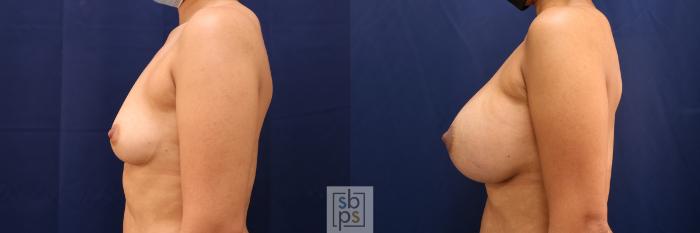 Before & After Breast Augmentation Case 555 Left Side View in Torrance, CA
