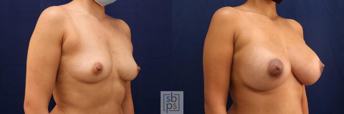 Before & After Breast Augmentation Case 555 Right Oblique View in Torrance, CA