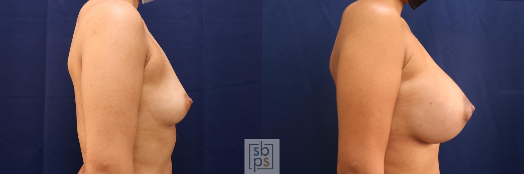 Before & After Breast Augmentation Case 555 Right Side View in Los Angeles, Torrance & Long Beach, CA
