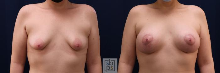 Before & After Breast Augmentation Case 563 Front View in Torrance, CA