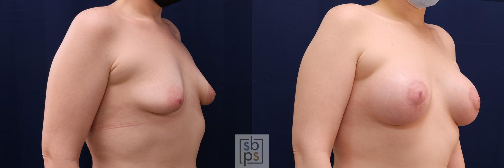 Before & After Breast Augmentation Case 563 Left Oblique View in Los Angeles, Torrance & Long Beach, CA