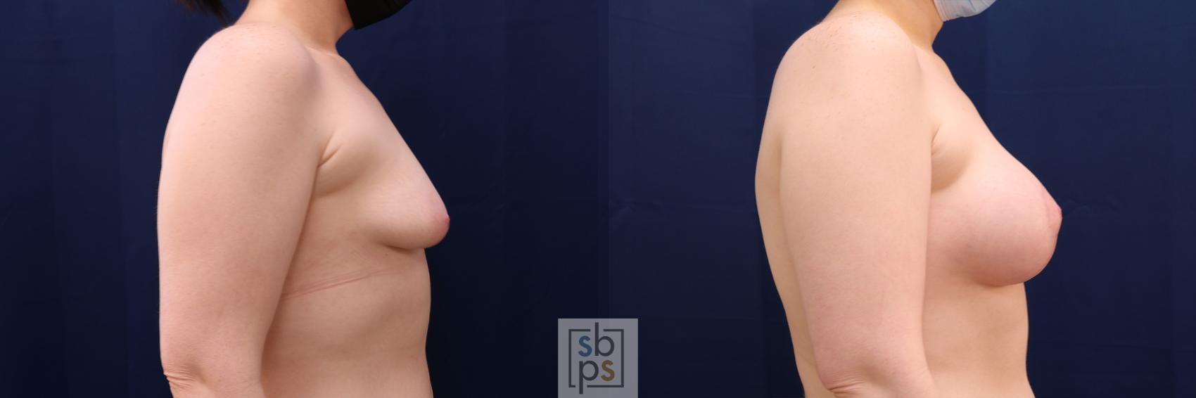 Before & After Breast Augmentation Case 563 Left Side View in Los Angeles, Torrance & Long Beach, CA