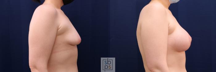 Before & After Breast Augmentation Case 563 Left Side View in Torrance, CA