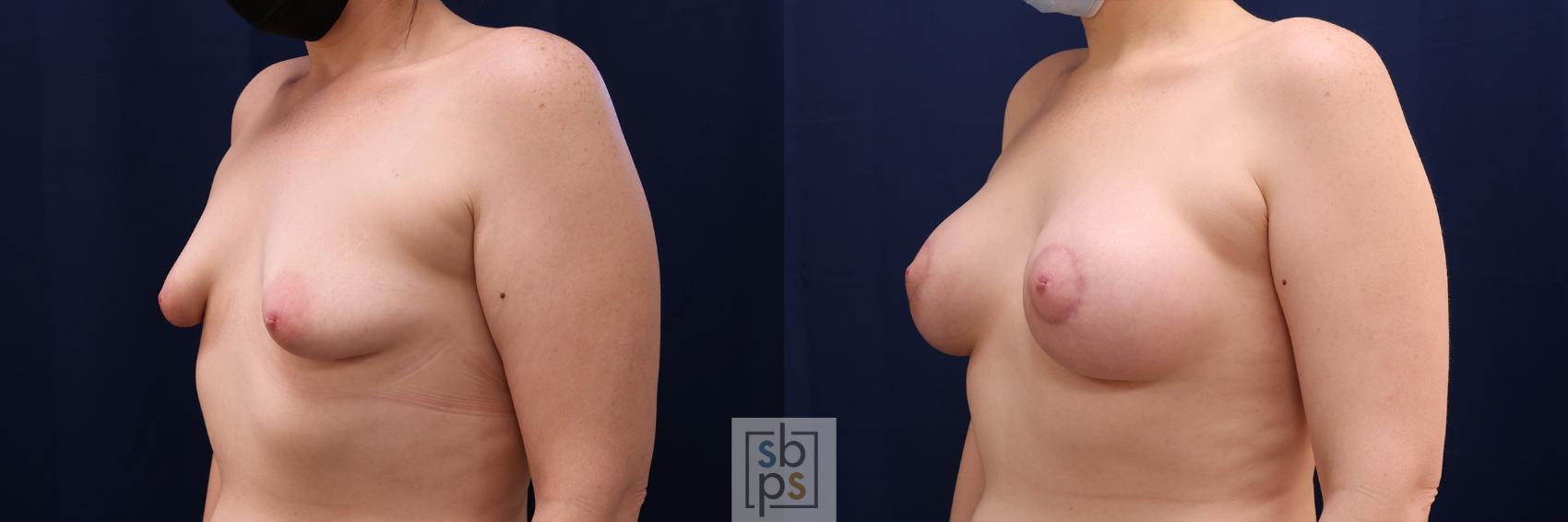 Before & After Breast Augmentation Case 563 Right Oblique View in Los Angeles, Torrance & Long Beach, CA